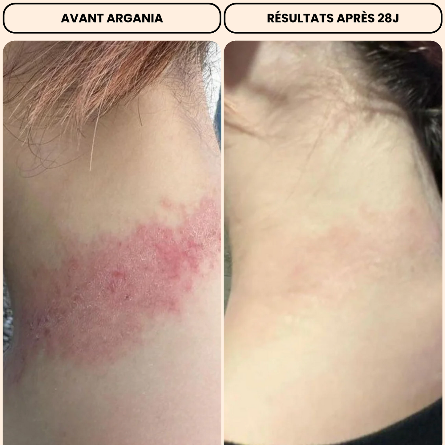 Nigella Aura® 30ml - Pure black cumin oil, for psoriasis, eczema and acné🇨🇭