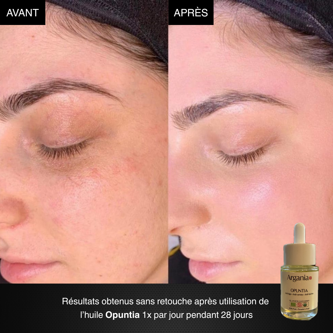 Prima e dopo Opuntia® — risultati reali senza ritocchi dopo 28 giorni